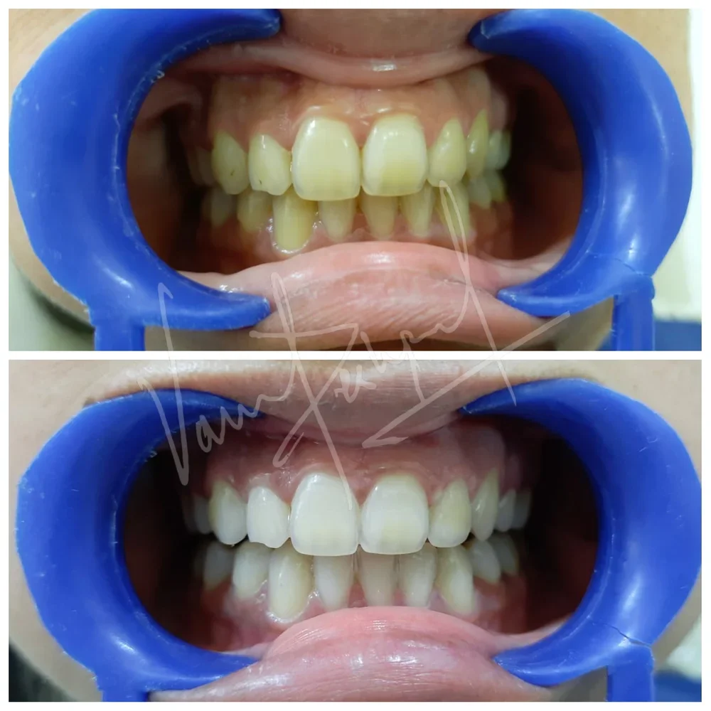 Zoom Teeth Whitening - Image 15