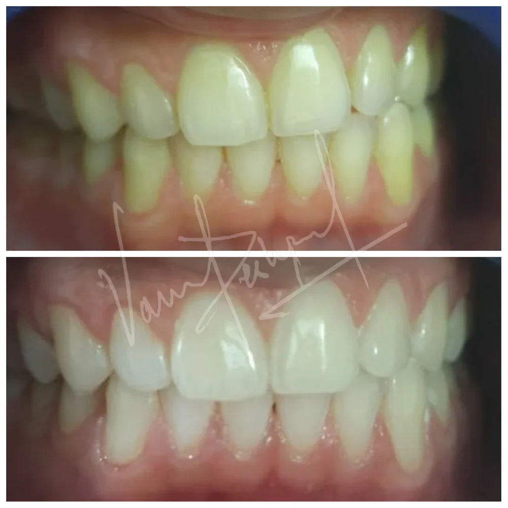 Zoom Teeth Whitening - Image 16