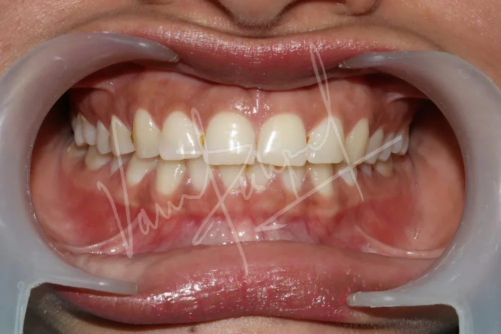 Zoom Teeth Whitening - Image 2