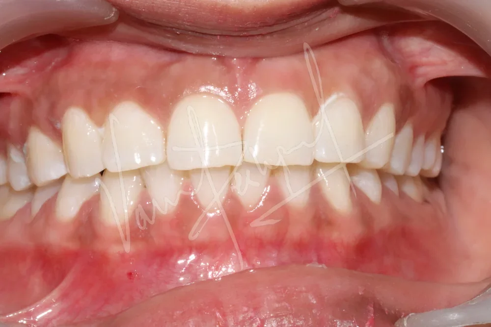 Zoom Teeth Whitening - Image 3