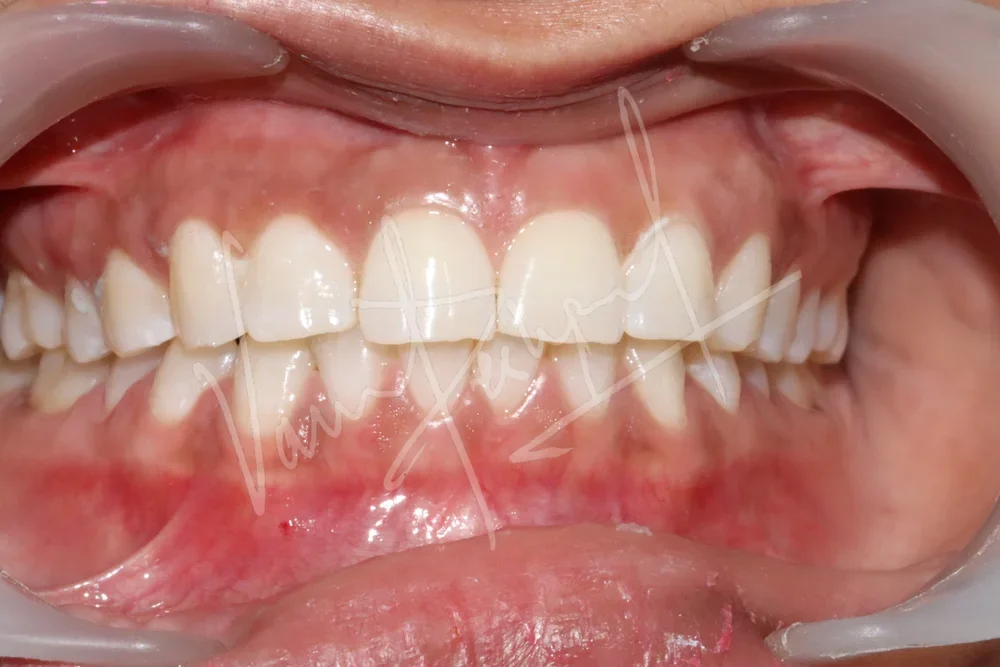Zoom Teeth Whitening - Image 4