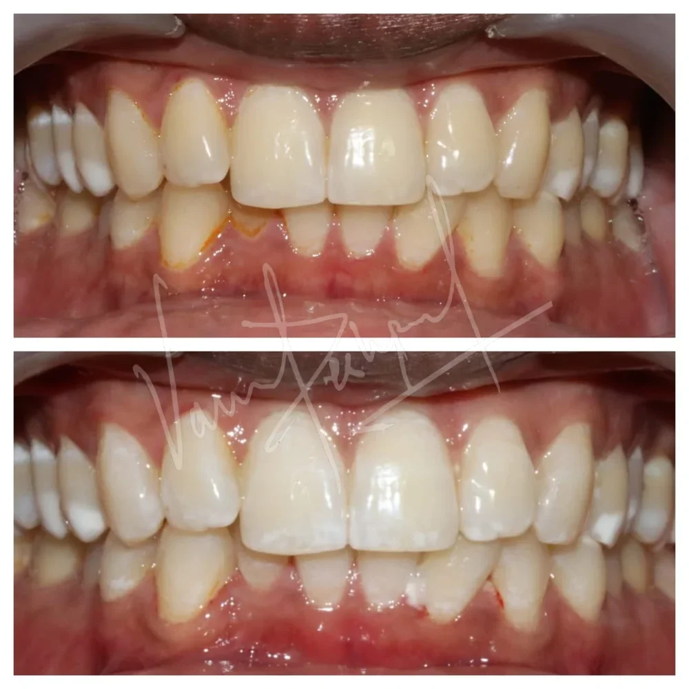 Zoom Teeth Whitening - Image 6