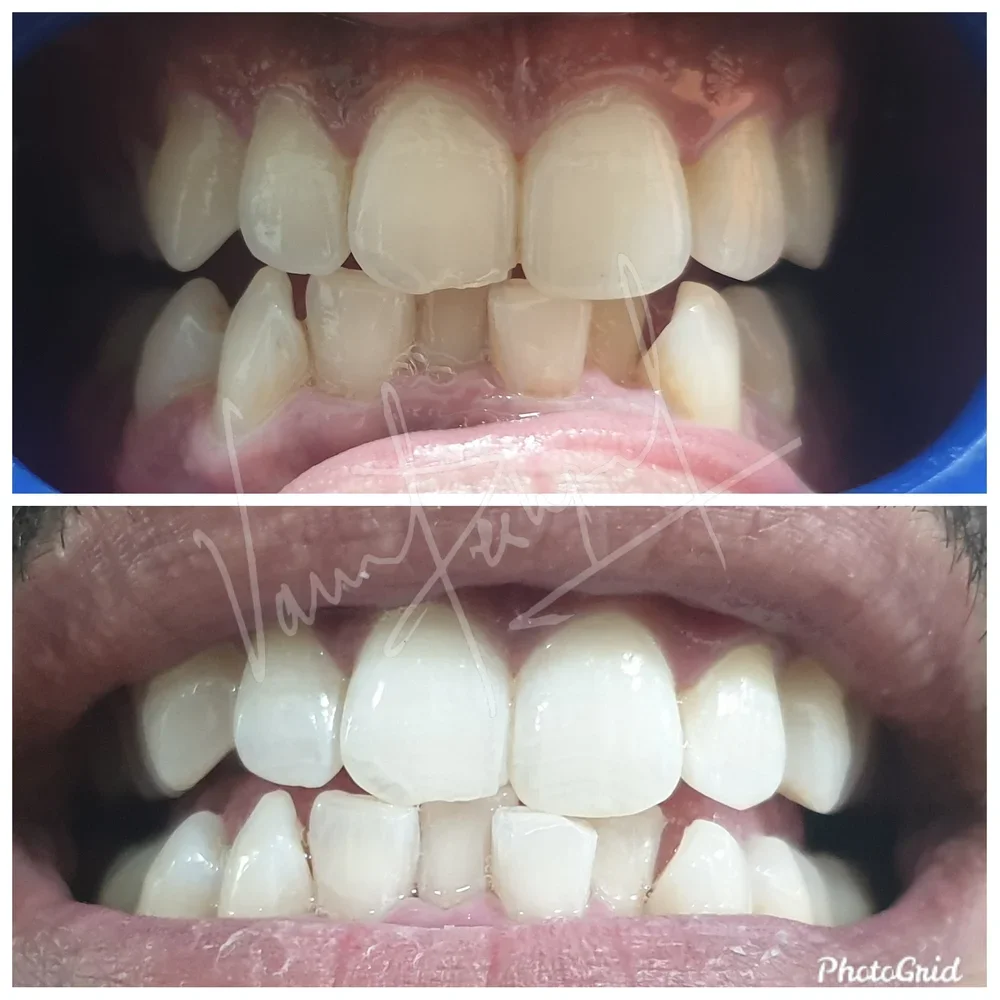 professional whitening treatment